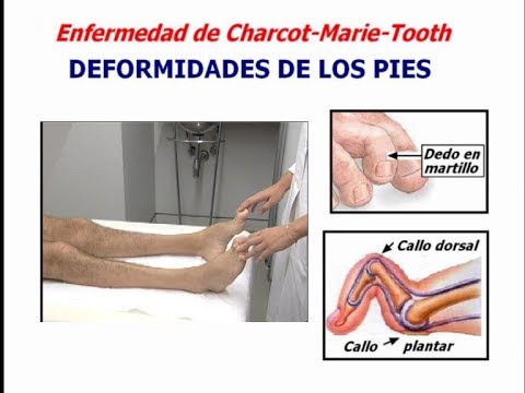 Enfermedad de Charcot-Marie-Tooth